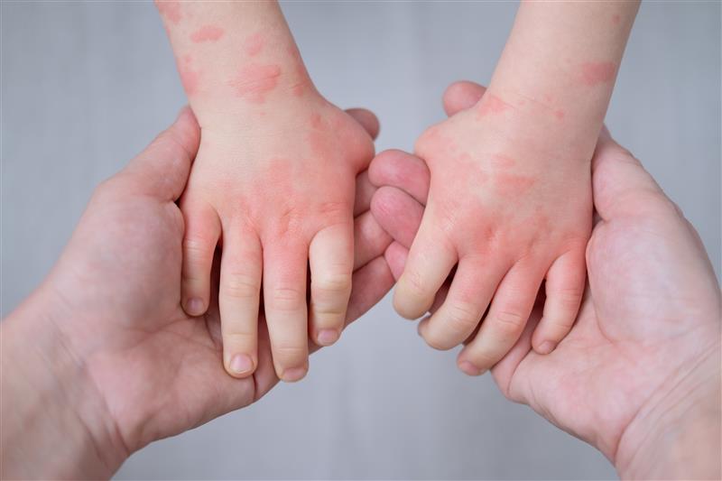 Investigating the impact of cow’s milk allergy interventions on infants’ gut microbiomes